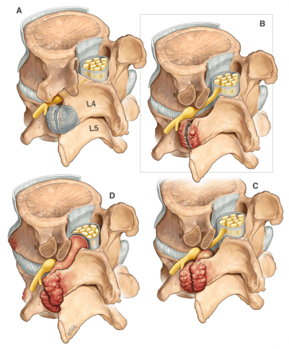 Facet Joint degeneration | EndoSpine