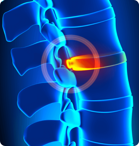 Herniated bulging disc | EndoSpine