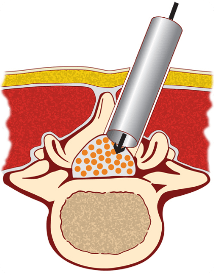 MIS Laminectomy | EndoSpine