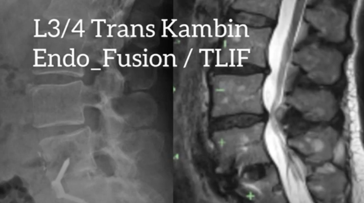 Endo Fusion | EndoSpine